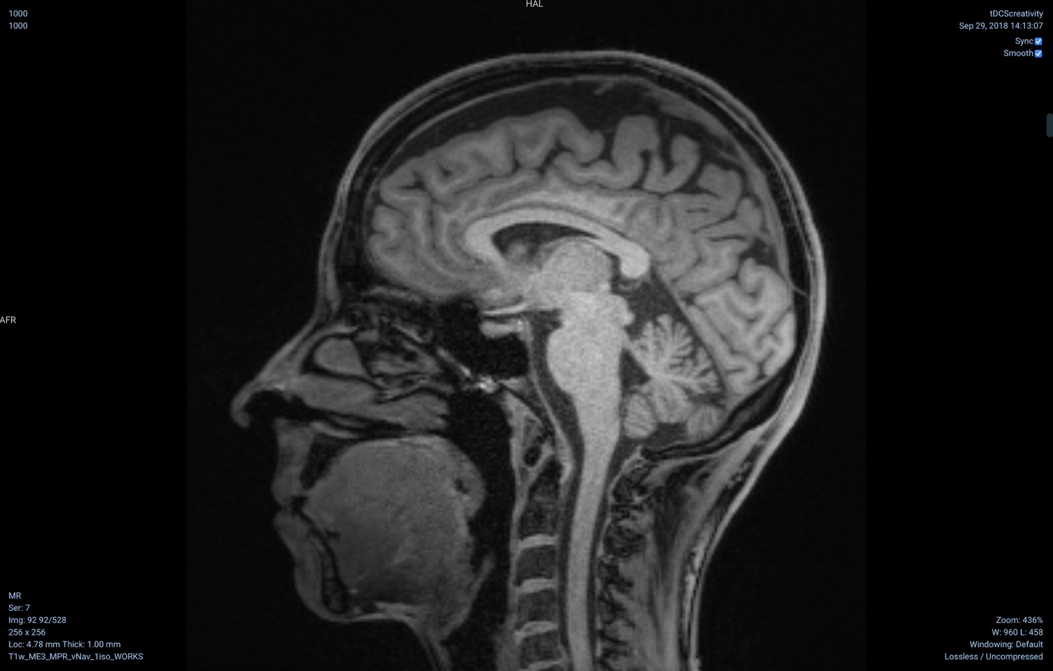 Carola Salvi brain image
